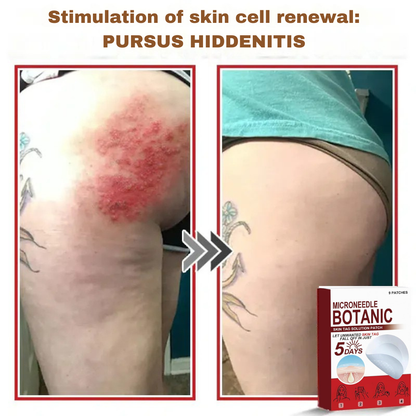 Plant-based wart and mole removal patches