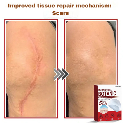Plant-based wart and mole removal patches