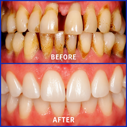 Hormonra® 𝑭𝒐𝒄𝒖𝒔𝒔𝒎𝒊𝒍𝒆 – Oral care powder containing bee venom 🦷🦷