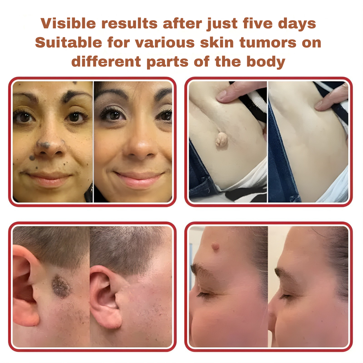Plant-based wart and mole removal patches