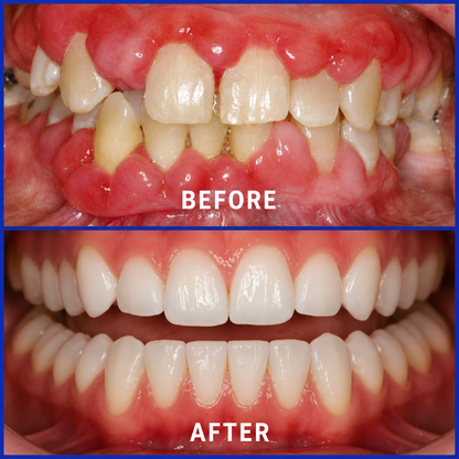 Hormonra® 𝑭𝒐𝒄𝒖𝒔𝒔𝒎𝒊𝒍𝒆 – Oral care powder containing bee venom 🦷🦷