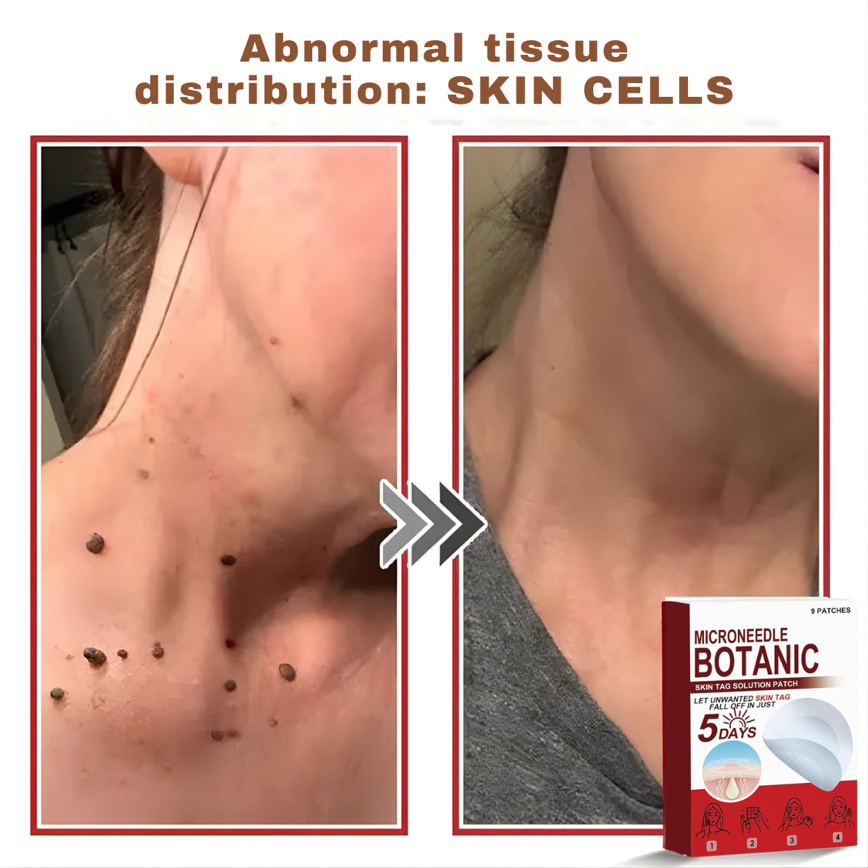 Plant-based wart and mole removal patches