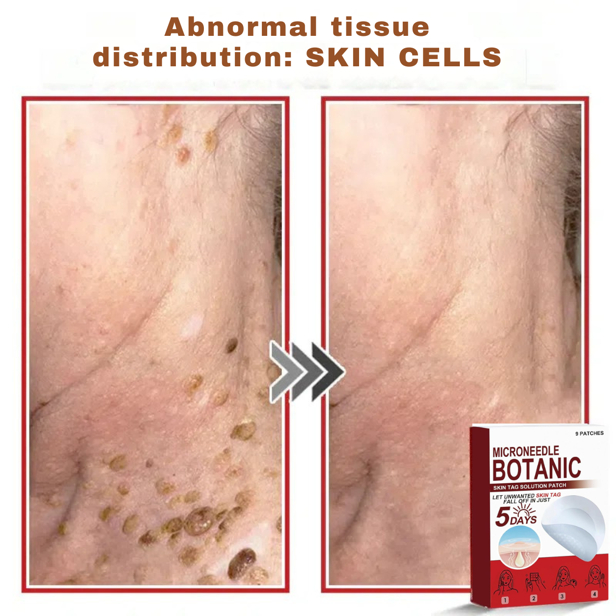 Plant-based wart and mole removal patches