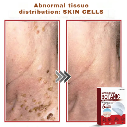 Plant-based wart and mole removal patches