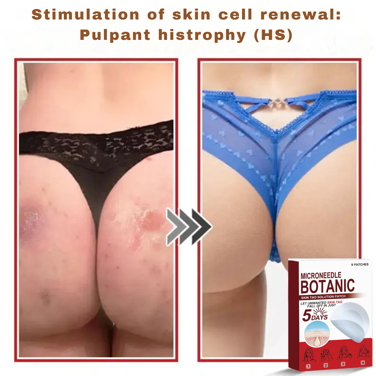 Plant-based wart and mole removal patches